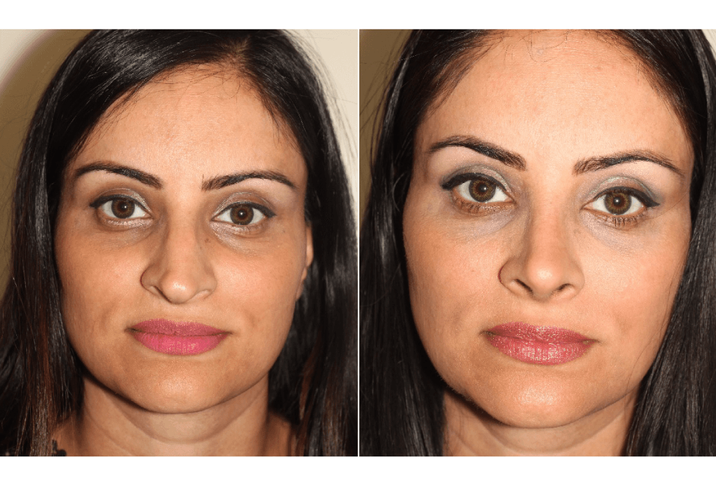 Dr. Denton Rhinoplasty before and after photo of a female patient