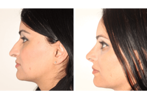 Dr. Denton Rhinoplasty before and after photo of a female patient