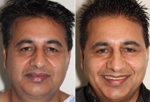 Dr. Denton blepharoplasty before and after photo of a male patient