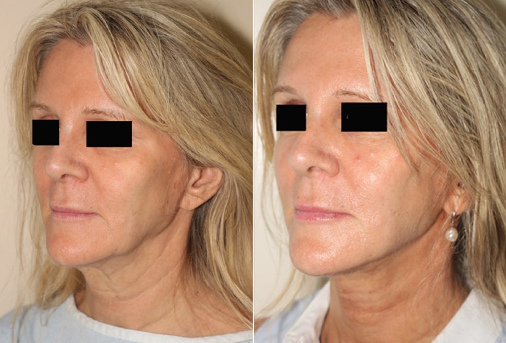 Facelift Surgery Vancouver (Rhytidectomy) - Dr Anzarut Plastic