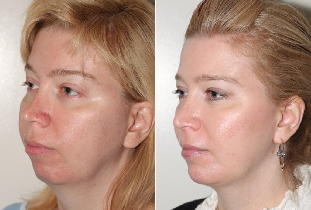 Dr. Denton chin implant before and after photo of a female patient