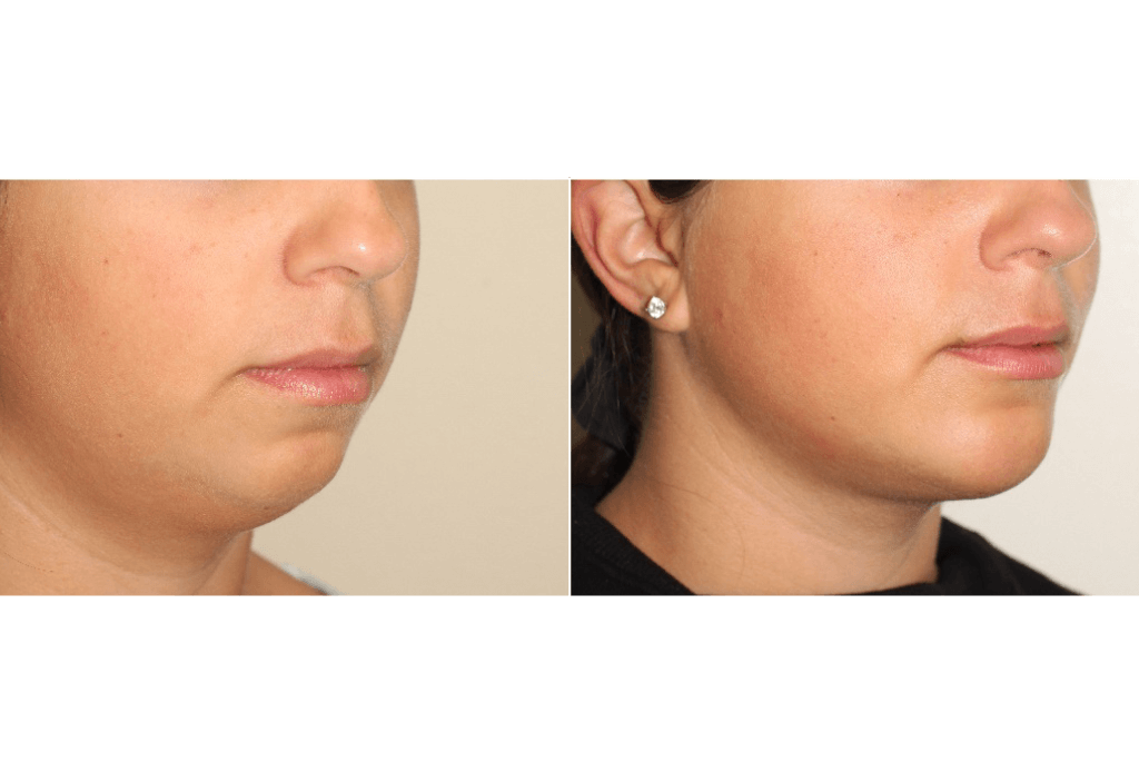 Dr. Denton liposuction before and after photo of a female patient