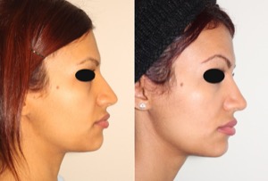 Dr. Denton Rhinoplasty before and after photo of a female patient