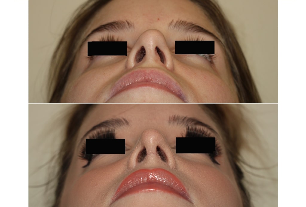 Dr. Denton Rhinoplasty before and after photo of a female patient