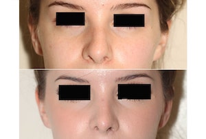 Dr. Denton Rhinoplasty before and after photo of a female patient