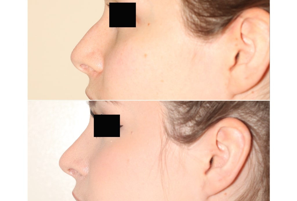 Dr. Denton Rhinoplasty before and after photo of a female patient