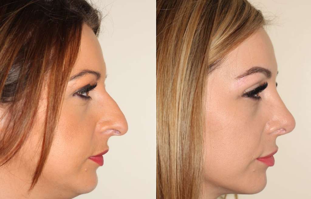 Revision Rhinoplasty