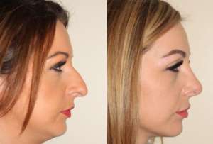 Dr. Denton Rhinoplasty before and after photo of a female patient