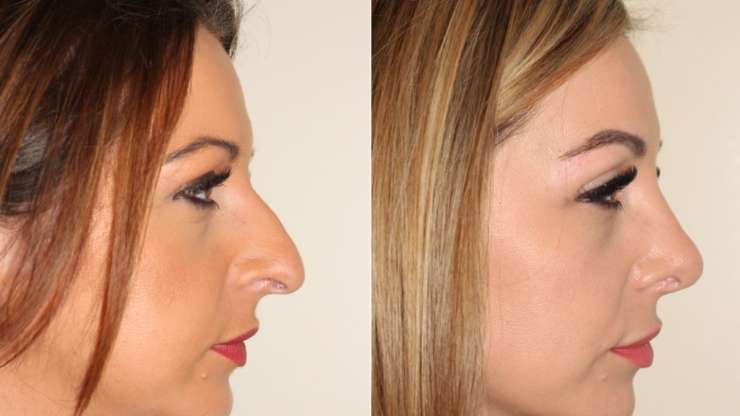 Revision Rhinoplasty