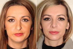 Dr. Denton Rhinoplasty before and after photo of a female patient