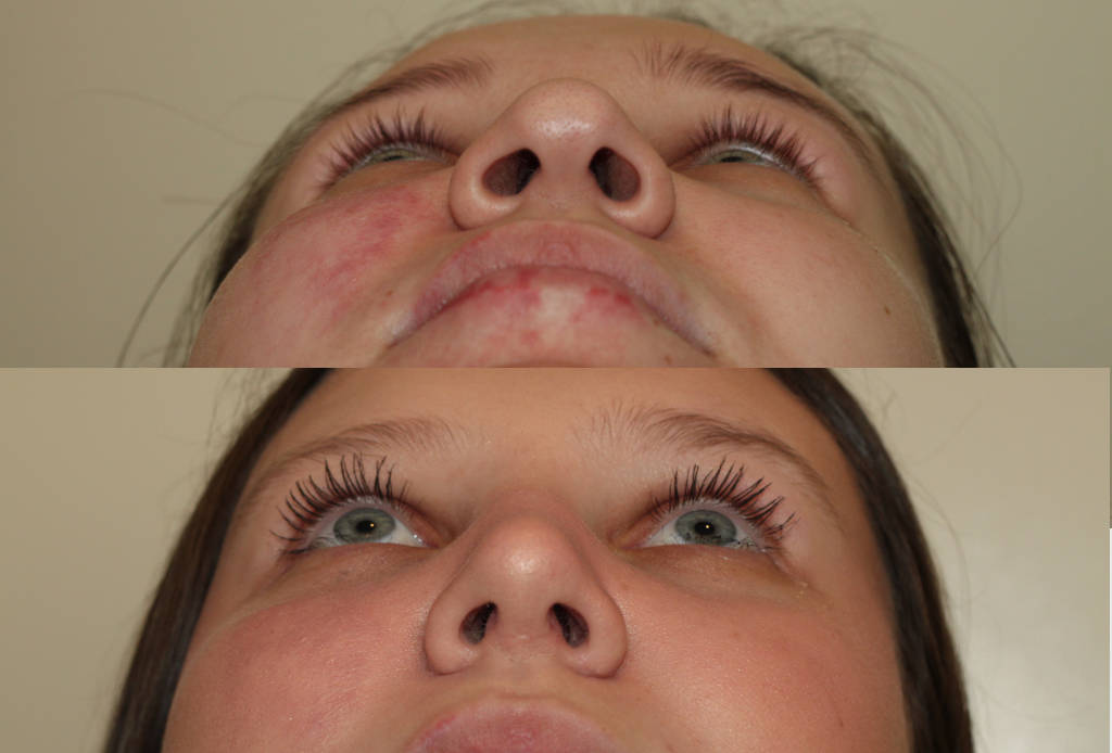 Dr. Denton Rhinoplasty before and after photo of a female patient