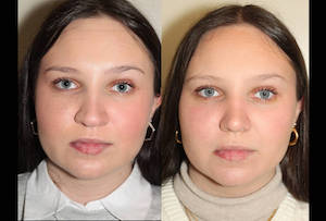 Dr. Denton Rhinoplasty before and after photo of a female patient