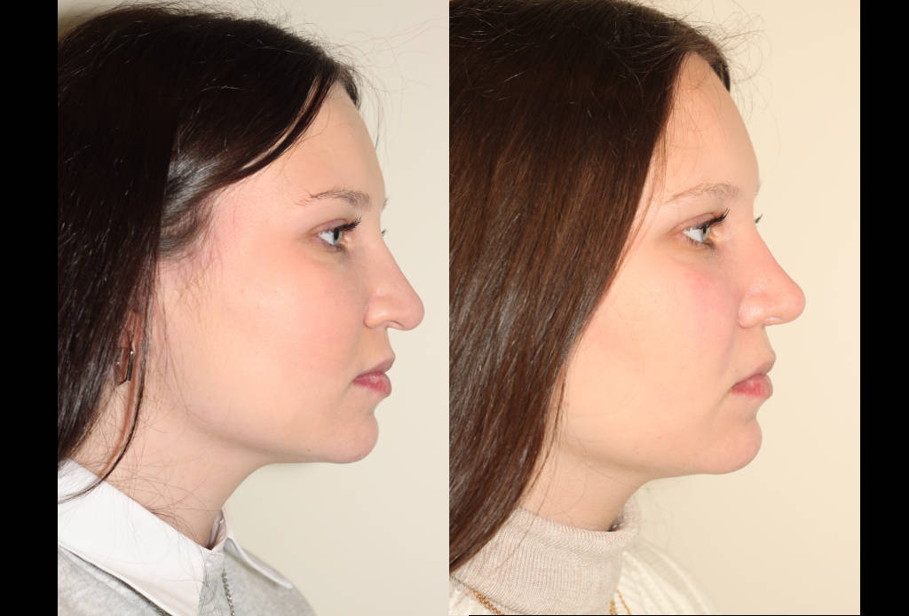 Dr. Denton Rhinoplasty before and after photo of a female patient