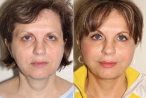 Dr. Denton facelift before and after photo of a female patient