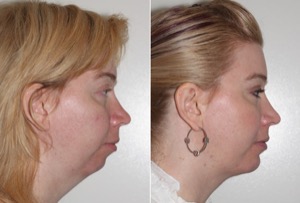 Dr. Denton chin implant before and after photo of a female patient