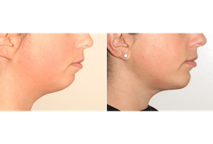 Dr. Denton liposuction before and after photo of a female patient