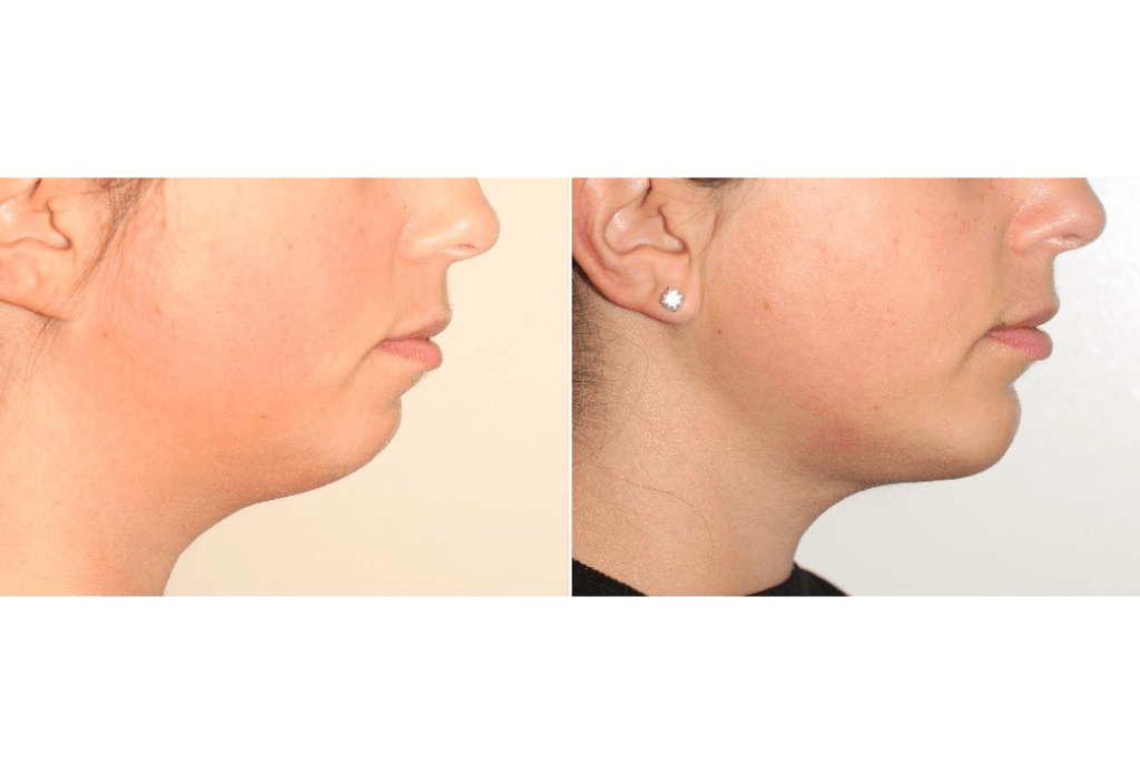 Dr. Denton liposuction before and after photo of a female patient