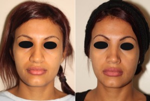 Dr. Denton Rhinoplasty before and after photo of a female patient