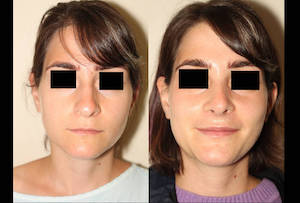 Dr. Denton Rhinoplasty before and after photo of a female patient