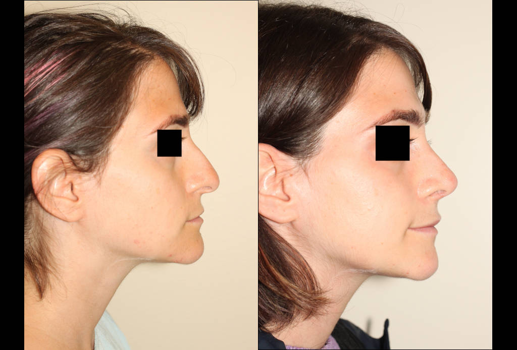 Dr. Denton Rhinoplasty before and after photo of a female patient