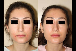 Dr. Denton Rhinoplasty before and after photo of a female patient