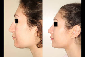 Dr. Denton Rhinoplasty before and after photo of a female patient