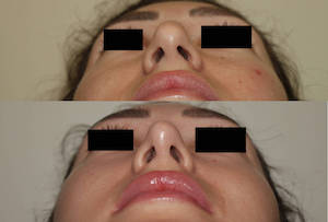 Dr. Denton Rhinoplasty before and after photo of a female patient