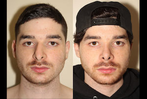 a before and after photo of a male who has undergone rhinoplasty