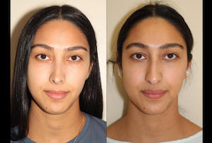 a before and after photo of a female who has undergone rhinoplasty