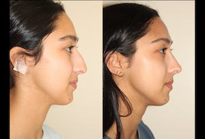 a before and after photo of a female who has undergone rhinoplasty