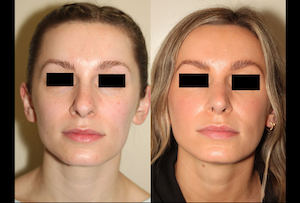 a before and after photo of a female who has undergone rhinoplasty