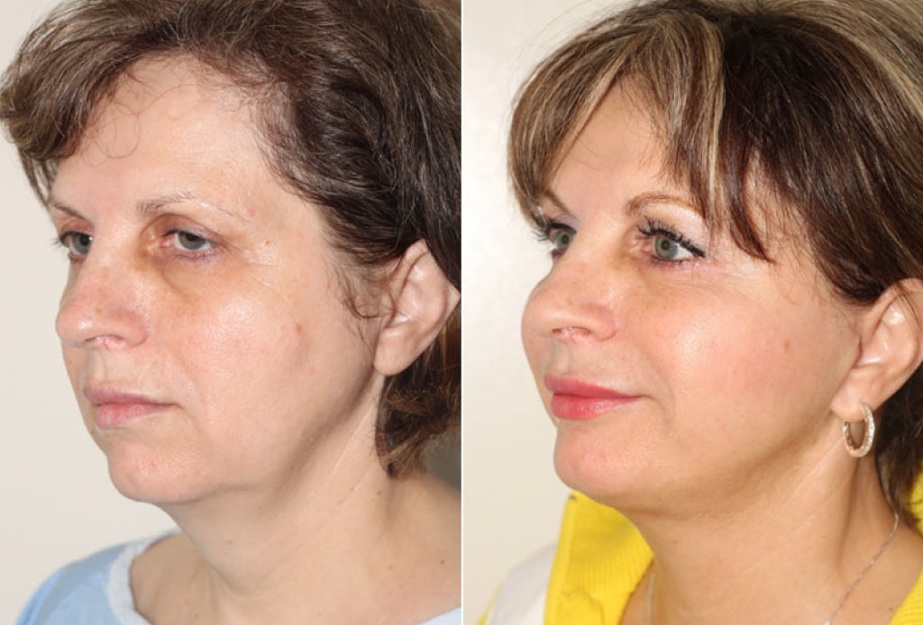 Dr. Denton facelift before and after photo of a female patient