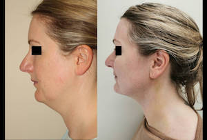 Dr. Denton liposuction before and after photo of a female patient