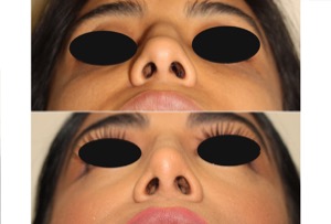 Dr. Denton Rhinoplasty before and after photo of a female patient