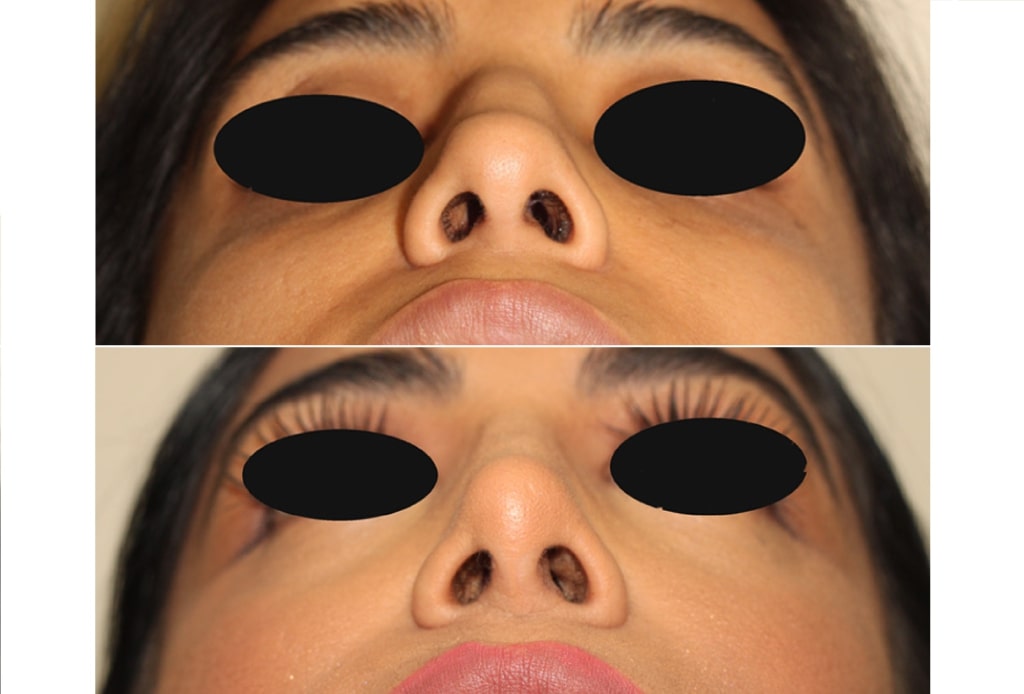 Dr. Denton Rhinoplasty before and after photo of a female patient