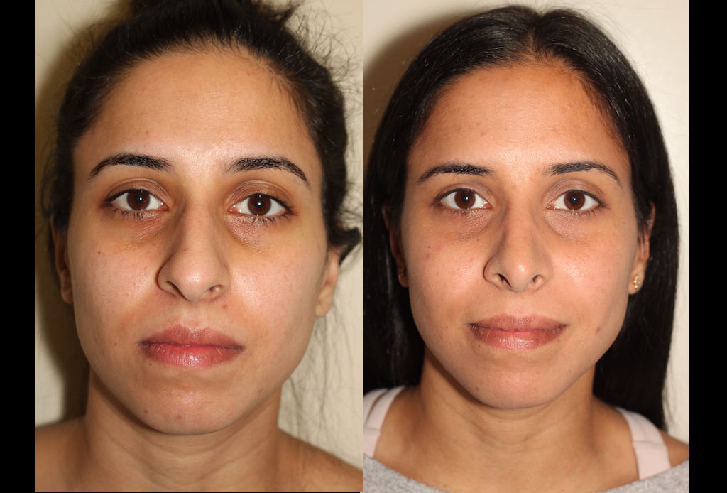 a before and after photo of a female who has undergone rhinoplasty