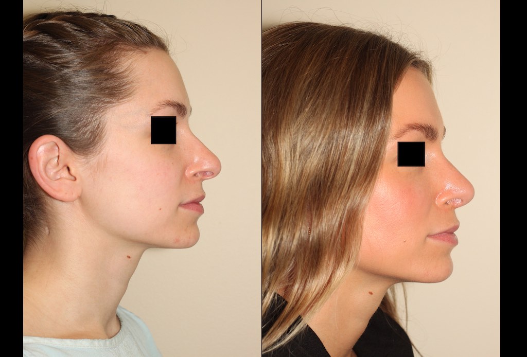 a before and after photo of a female who has undergone rhinoplasty