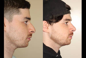 a before and after photo of a male who has undergone rhinoplasty