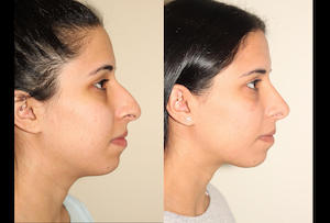 a before and after photo of a female who has undergone rhinoplasty