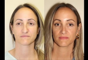 Before & After images of Facial liposuction of a young woman