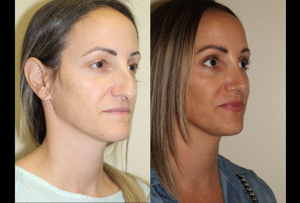 Before & After images of Facial liposuction of a young woman