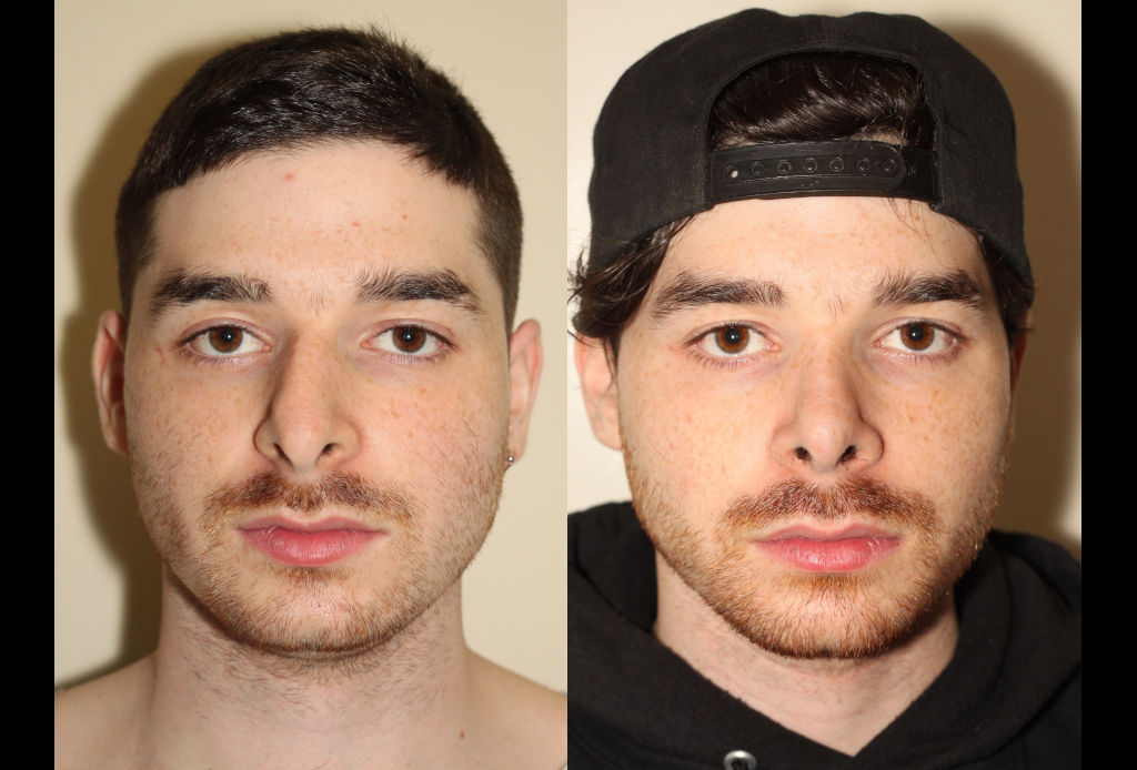 Before & After images of Facial liposuction of a young man