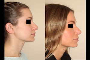 Before & After images of Facial liposuction of a young woman