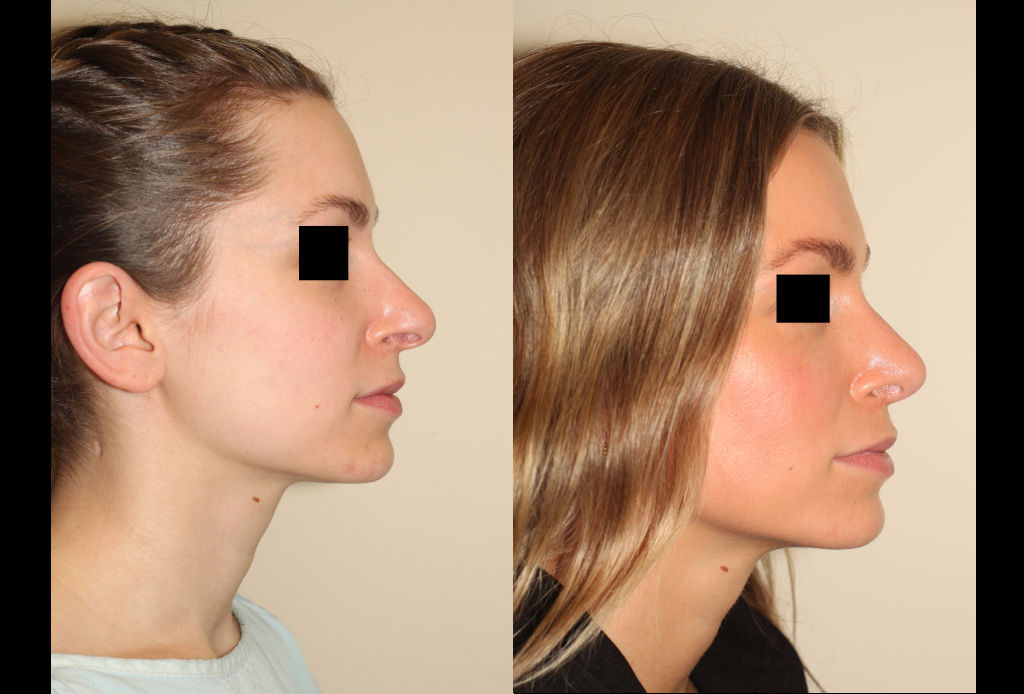 Before & After images of Facial liposuction of a young woman