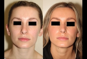 Before & After images of Facial liposuction of a young woman