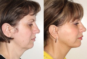 Dr. Denton facelift before and after photo of a female patient