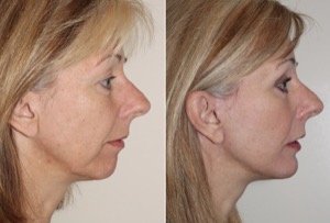 Dr. Denton chin implant before and after photo of a female patient