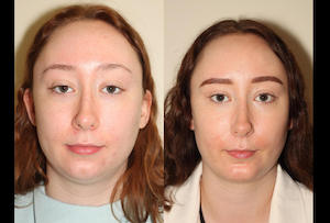 a before and after photo of a female who has undergone facial liposuction