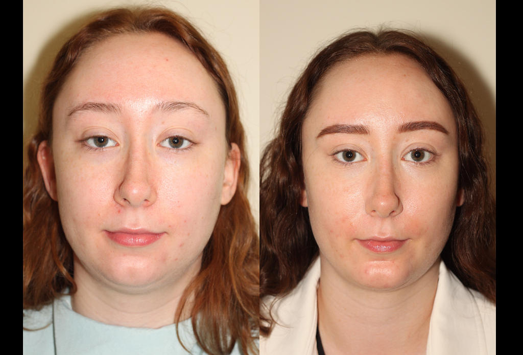 a before and after photo of a female who has undergone facial liposuction