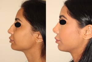 Dr. Denton Rhinoplasty before and after photo of a female patient